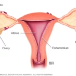 Endometriosis