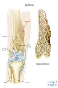 Osteosarcoma