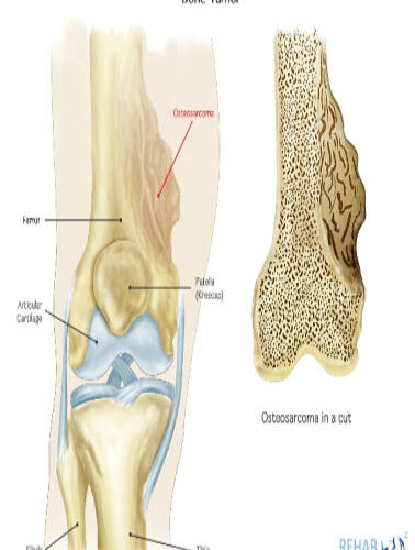 Osteosarcoma