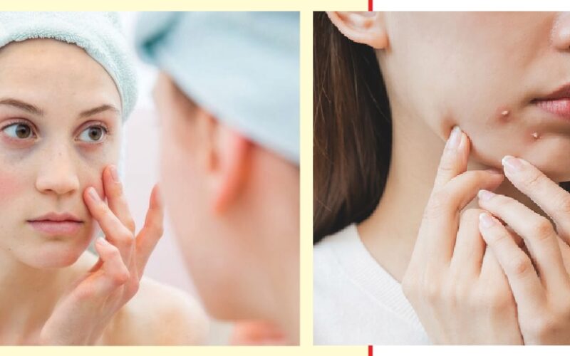 Make sure the pimple is actually ready to pop When it comes to caring for our skin, popping pimples is a huge no-no. Although we are told we are not supposed to do it, we all pop our zits from time to time. There is something so satisfying, addictive even, about getting the gunk out of our faces. If you just can’t stop popping your own zits, these are some things dermatologists want you to keep in mind. Pop the right pimple First of all, the pimple you are trying to pop has to be ready. In essence, you are looking for a pimple with a white tip, known as a pustule, or more commonly, a whitehead. If the pimple you are trying to pop is a deeper nodule (the firm, painful red kind), you should avoid it altogether. The inflammation and debris and pus can spill underneath the skin when popped wrongly; that’s what leads to further inflammation, infection and even scarring. Cleanliness is key Next, you need to make sure the area and your hands are cleaned thoroughly. According to the expert, if a pimple has a clear ‘whitehead’, then you can wash your hands and wash the area with soap and water and apply gentle pressure from both sides. Use the right tools It is advised that the right tools should be used if pimples must be popped. Know when to stop Another thing to keep in mind, however badly you want to push and press at your zits, is to be gentle. When you actually pop your pimples, you want to just gently compress the area. You don’t want to squeeze too aggressively. Preventive measures According to Lamb, Isaac and the Palmisanos, the best and safest thing to do is to see a professional. You can also try topical treatments to help dry out your pimples, which may help mitigate the desire to pop them. These treatments should be used in small amounts, once or twice a day.