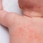 What every student needs to know about Stevens-Johnson syndrome